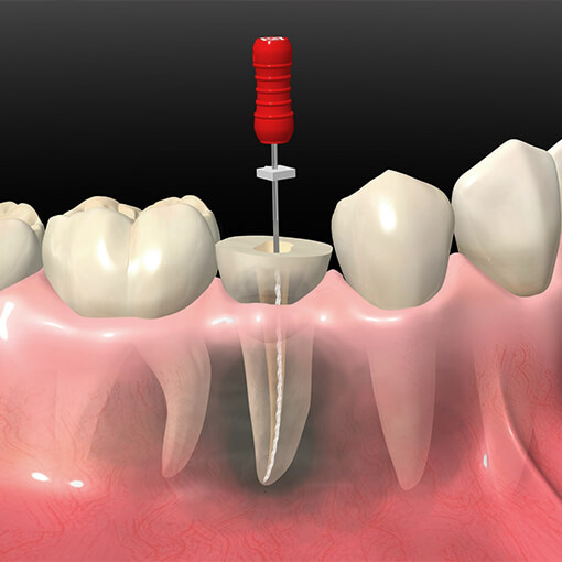 一般歯科編　根管治療